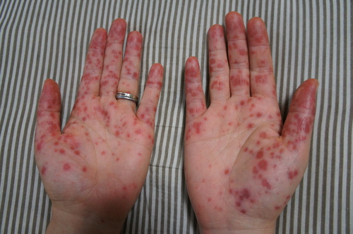 手足口病の湿疹